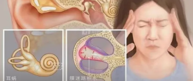 眩晕+耳鸣+耳闷+听力下降，要高度怀疑美尼尔病