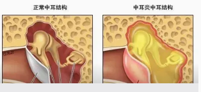 开学了，孩子上课“听不见”可能是分泌性中耳炎在作怪