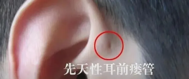 耳前的“小孔”是福是祸？很多人误以为是“聪明孔”