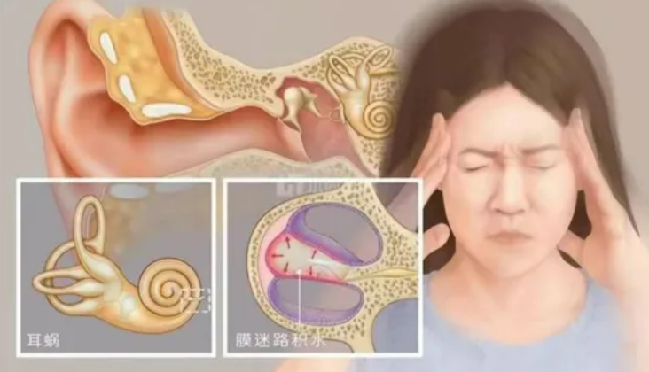 眩晕+耳鸣+耳闷+听力下降，高度怀疑美尼尔病