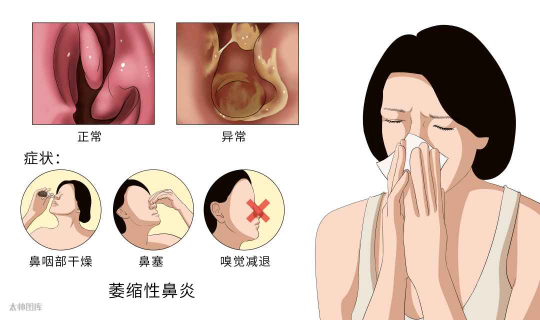同样是鼻炎，为什么你的症状和别人不一样？