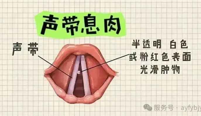 嗓子哑了半个月没好？声带息肉了解一下